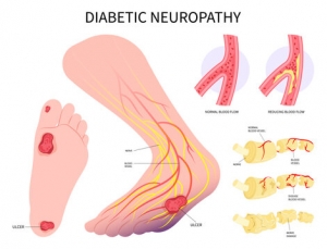 Diabetic Peripheral Neuropathy Market Size, Trends, and Growth Strategies 2025-2032
