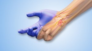 Carpal Tunnel Release System Market: Size, Trends, and Strategic Outlook 2025-2032