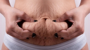 Post-Pregnancy Stretch Marks: Best Treatment Options in 2025