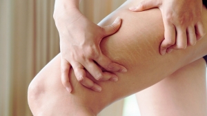 Stretch Marks Treatment: Top 5 Stretch Marks Removal Methods Backed by Dermatologists