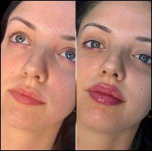Fillers in Dubai for Non-Surgical Jawline Fillers Enhancement
