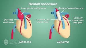 Procédure Bentall en Inde : chirurgie cardiaque de pointe à prix raisonné