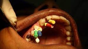 Aftercare Tips for Root Canal Recovery