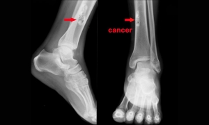 Osteosarcoma Treatment Market Size, Trends, and Strategic Outlook 2025-2032