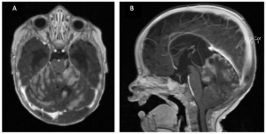 Pediatric Brain Tumors Market Size, Trends, and Growth Forecast 2025-2032