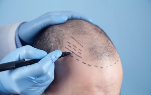 What to Expect During a Crown Hair Transplant Procedure