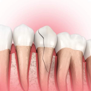 Cracked Tooth Treatment in Virginia for Active Lifestyles