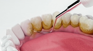 The Benefits of Professional Teeth Cleaning for a Healthier Smile