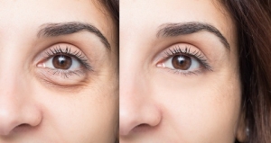 Best Plastic Surgeon in Dubai Shares Tips to Prevent and Treat Dark Circles Naturally