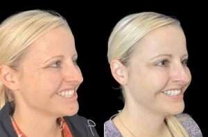 Smooth Fine Lines with the Best Plastic Surgeon in Dubai for Botox