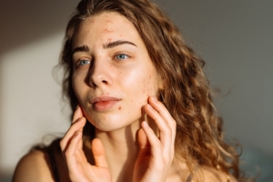 Who Provides Affordable Acne Treatment Dubai?