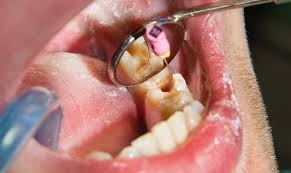 Tooth Pain Relief in Islamabad