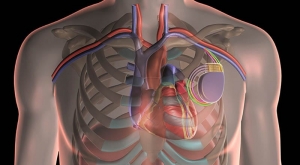 Cardiac Resynchronization Therapy Market Growth and Strategies 2025-2032