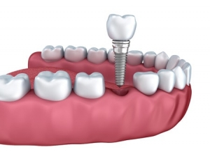 How Much Does a Tooth Implant Cost in Malaysia? Everything You Need to Know