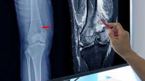 Ewing Sarcoma Treatment Market: Size, Trends, and Industry Growth