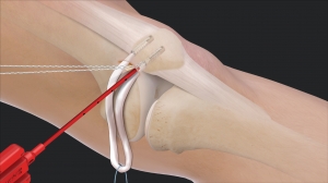 Joint Reconstruction Devices Market Trends, Size, Share, and Growth Forecast 2025-2032