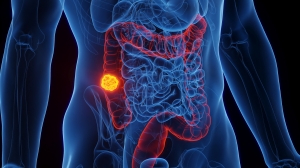 Metastatic Colorectal Cancer Market: Size, Dynamics, and Strategic Outlook