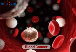 Comprendre le Traitement du cancer du sang en Inde