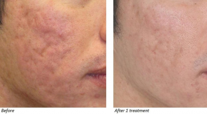 A Beginner’s Guide to Laser Acne Treatment