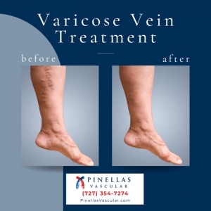 How to Know When You Should Treat Your Varicose Veins
