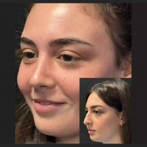 Rhinoplasty in Dubai: Crafting the Perfect Nose