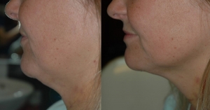 Stunning Results: Neck Liposuction Before and After Images