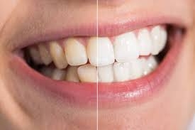 What’s the Difference Between Whitening and Stain Removal?