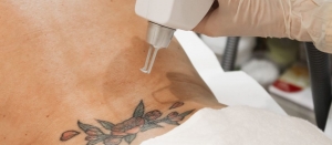 Skin Confidence Hits New Levels with Laser Tattoo Removal