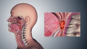 Strategic Outlook on Oropharyngeal Cancer Market Size, Trends, and Growth