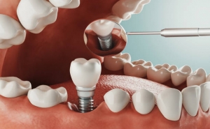 Can I Get Dental Implants if I Have Diabetes?