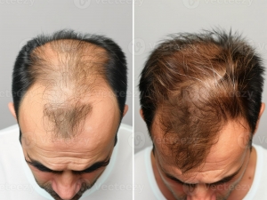 Finasteride for Hair Growth: Real Results and Long-Term Effects