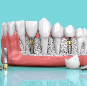 How All-on-4 Dental Implants Can Transform Your Smile