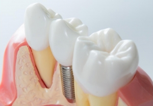 How Durable Are All-on-4 Dental Implants?