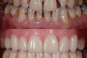 Perfect Your Smile with Dental Veneers in Islamabad