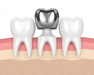How Long Do Dental Crowns Last?