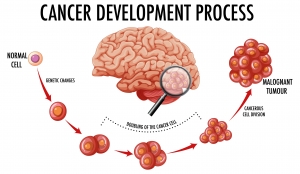 How to Prevent Brain Cancer – Practical Tips for a Healthy Brain