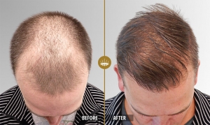 Dr. Naveed’s Hair Transplant – Can You Expect Guaranteed Results?