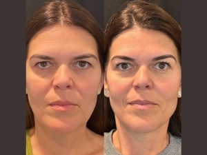 How to Choose the Best Plastic Surgeons in Dubai for Your First Thread Lift