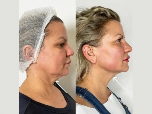 Best Plastic Surgeons in Dubai: Top Clinics Offering Endolift for Facial Rejuvenation