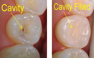 Dental Filling Solutions: Repair Cavities and Save Teeth