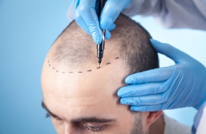 Before & After Gallery – Slide to See Real Hair Transplant Treatment Turkey Results