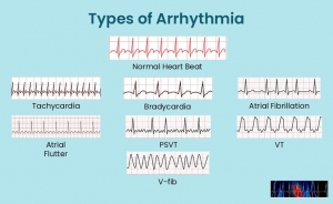 Best Arrhythmia Treatment Near Me for Heart Rhythm Care