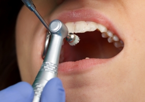 Teeth Cleaning vs. Teeth Whitening What’s the Difference?