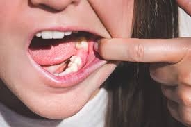 What Should I Expect Before Tooth Removal?