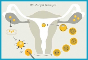 Transfert de blastocystes en Inde : Une solution avancée et abordable pour la fertilité