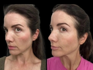 What to Expect Before, During, and After Dark Circles Treatment in Dubai