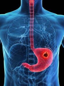 Stomach Cancer: Causes, Symptoms, and Treatment Options — Insights by Dr. Sachin Arora