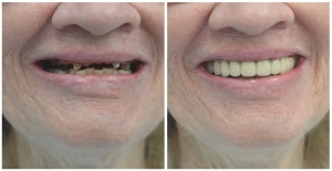Revive Your Dental Health with Dental Crown