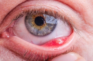 Chalazion Excision - Causes, Procedure &Recover