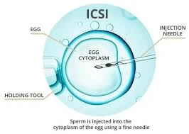 Injection intracytoplasmique de spermatozoïdes (ICSI) en Inde : Une solution de fertilité avancée et abordable